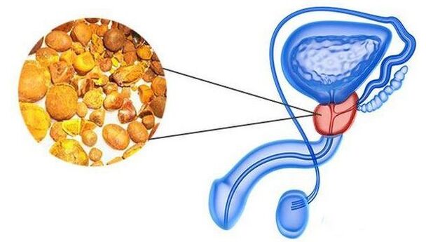 Calcinuje v prostate žľazy