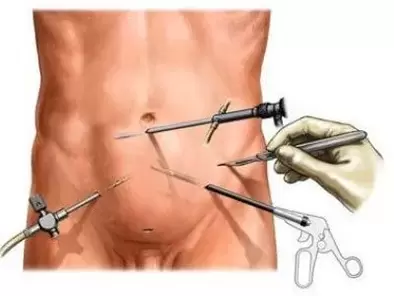 chirurgická liečba chronickej prostatitídy