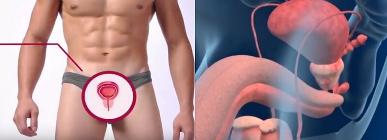 Prostatitída u mužov, rozpoznateľná podľa určitých znakov