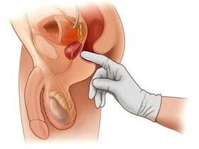 masáž prostaty pri prostatitíde