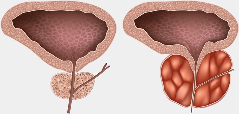 zdravá a zapálená prostata s prostatitídou