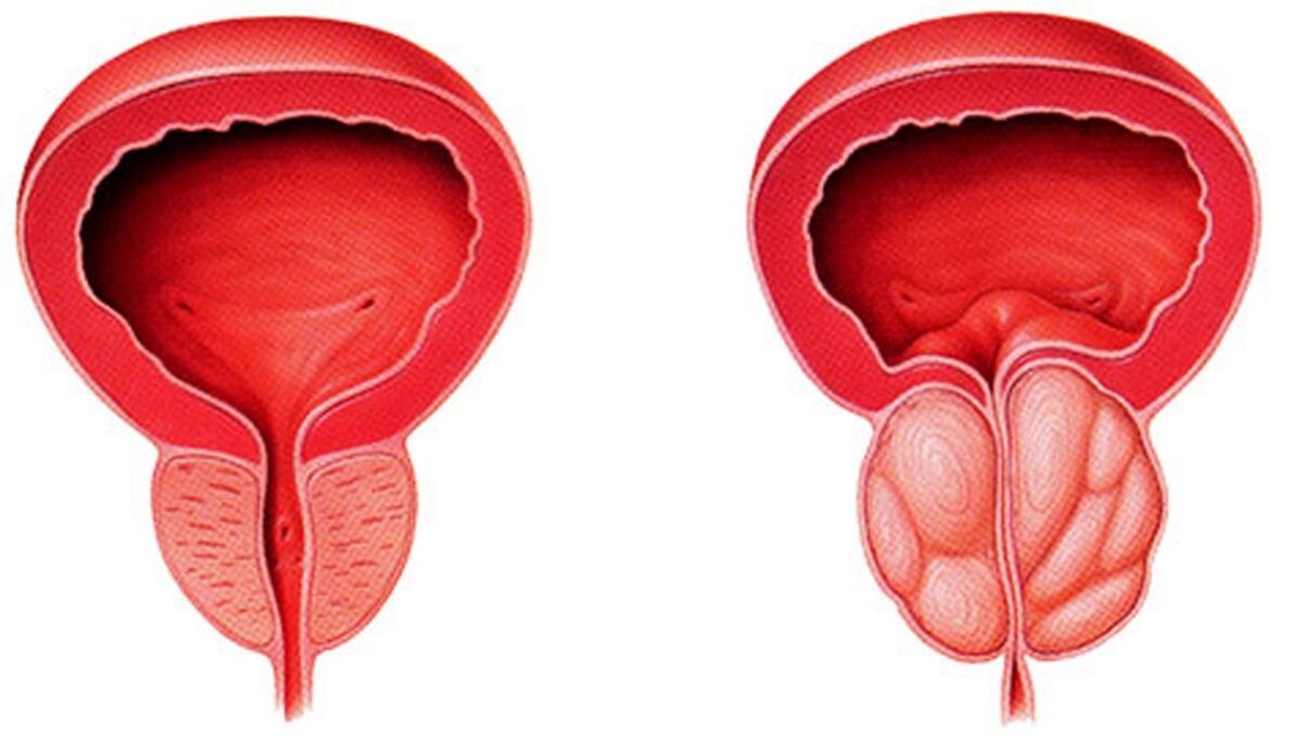 zdravá a zapálená prostata s prostatitídou