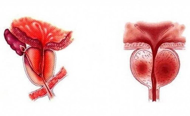 Akútny zápal prostaty, ktorý sa môže stať chronickým