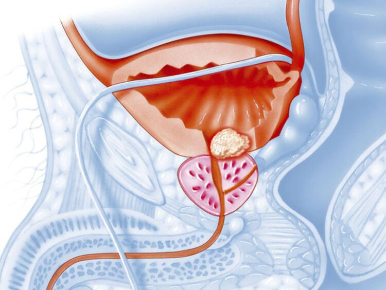 Pri chronickej prostatitíde sa lúmen močovej trubice zužuje, čo sťažuje odtok moču. 